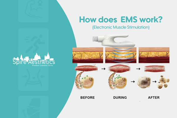 EMS treatment for post pregnancy weight loss treatment Small Heath