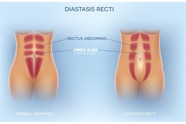 What Non-Surgical Options Are Available for Diastasis Recti Small Heath?