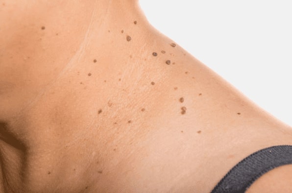 Are you looking for easy skin tag removal Small Heath - then contact Spire today!