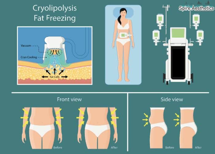 Image of diet and fat freezing combined for best results for Spire Aesthetics Small Heath