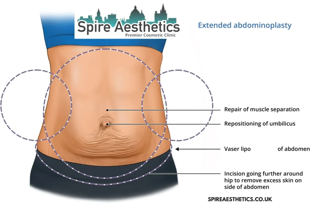 Understanding Loose Skin After Gastric Band Small Heath Surgery and HIFU Treatment