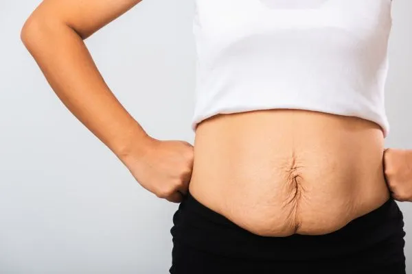 Image of a woman's stomach after weight loss with sagging skin following a gastric band Small Heath