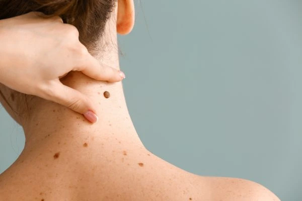 skin blemish removal Small Heath treatment