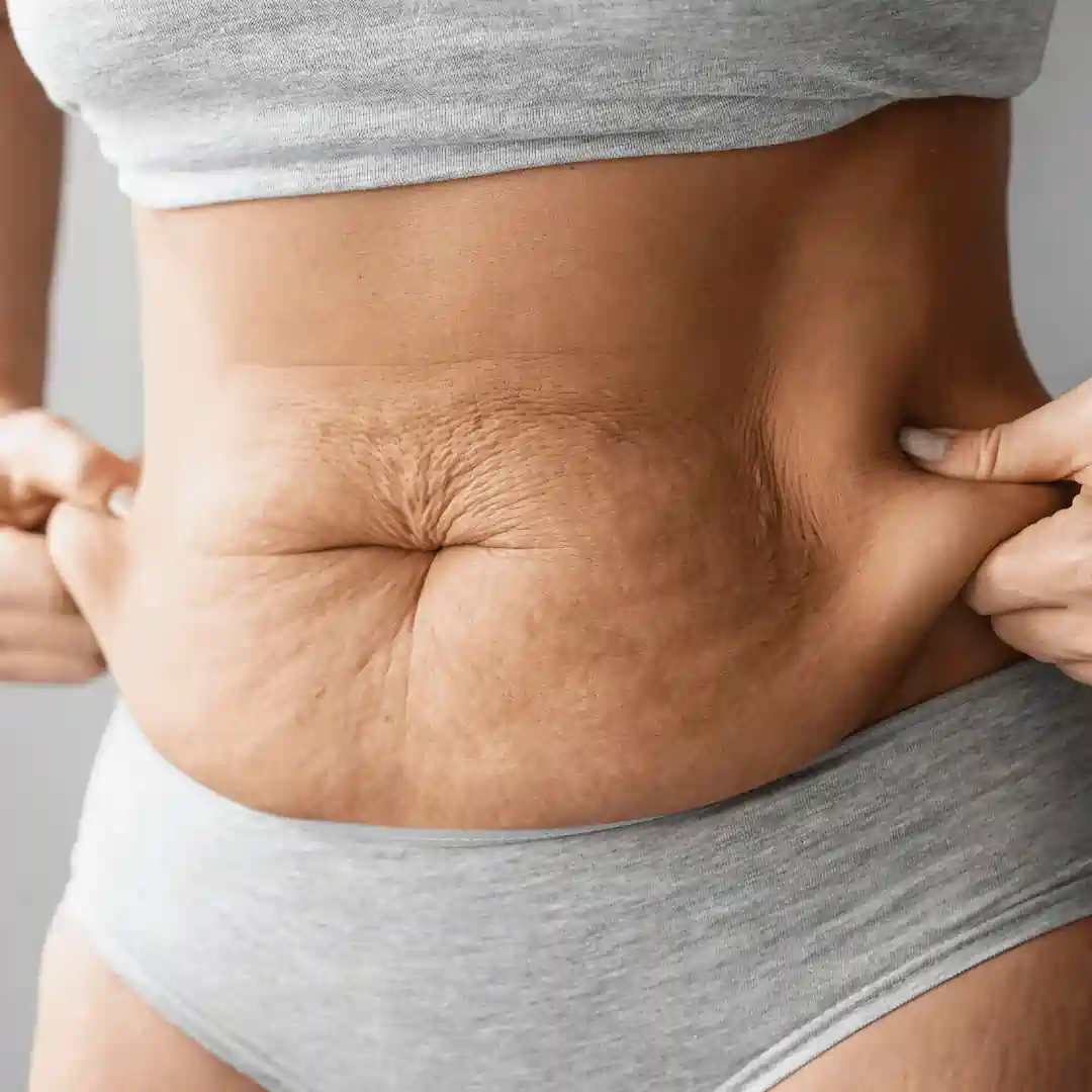 Is It Normal to Have Loose Skin After Pregnancy Small Heath?